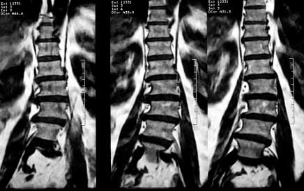 MRI of Degenerative Scoliosis
