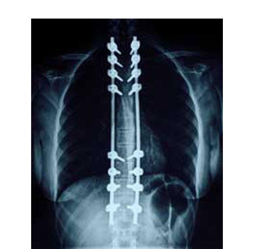 Scoliosis Surgical Correction